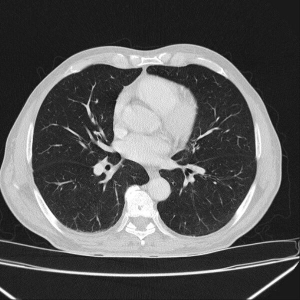 File:Azygos lobe (Radiopaedia 38259-40275 Axial lung window 46).jpg