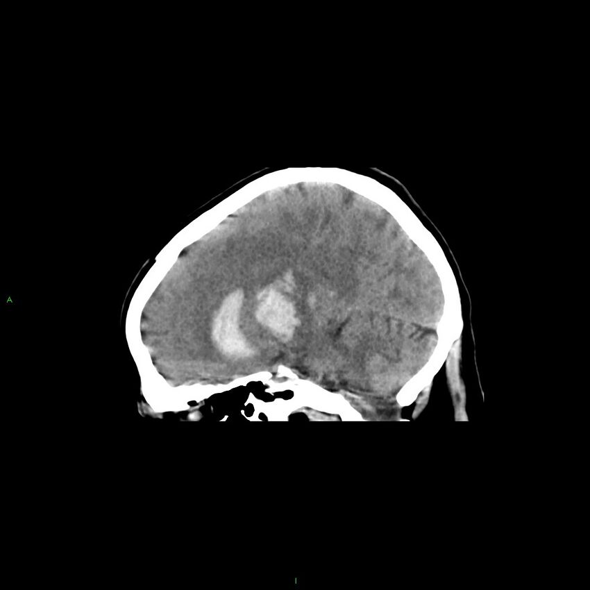 Basal ganglia hemorrhage (Radiopaedia 58349-65472 C 30).jpg