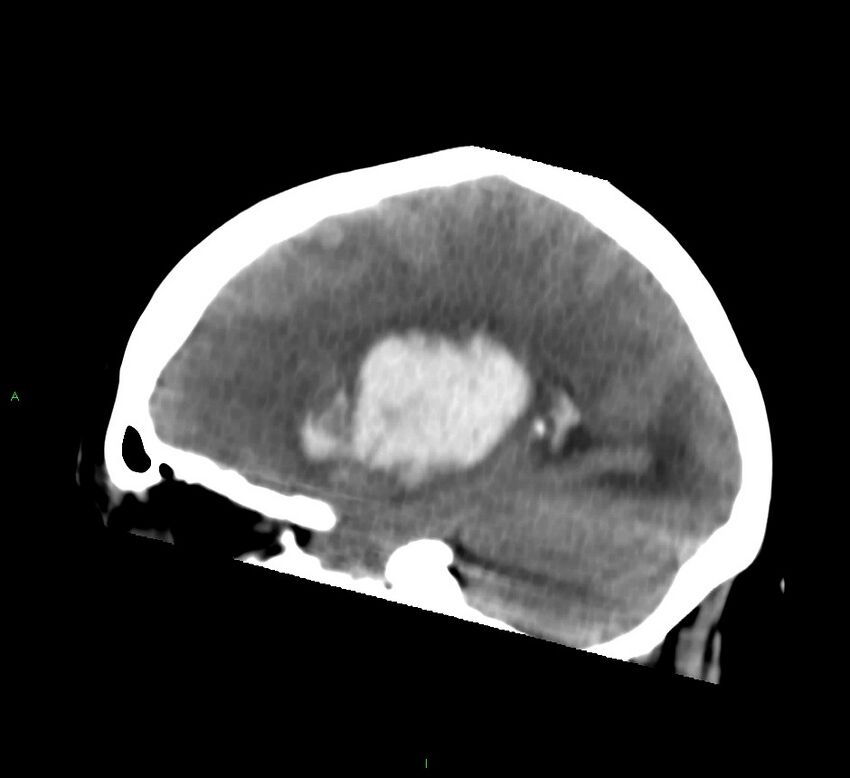 Basal ganglia hemorrhage (Radiopaedia 58759-65981 C 43).jpg