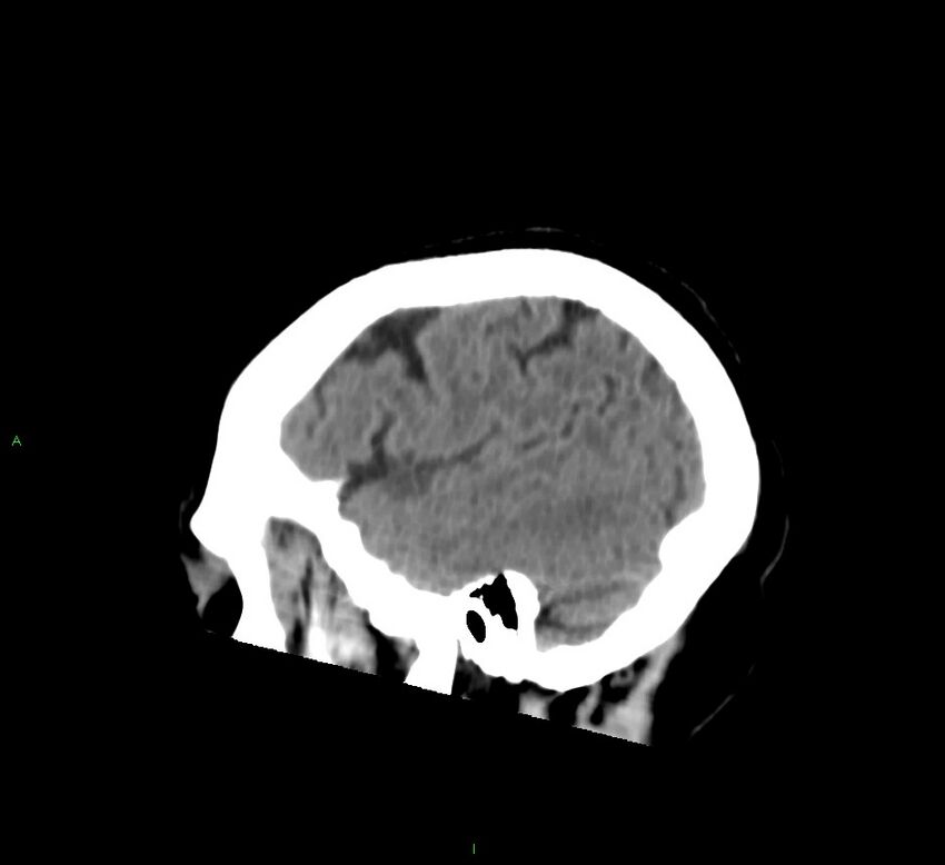 Basal ganglia hemorrhage (Radiopaedia 58763-65985 C 49).jpg