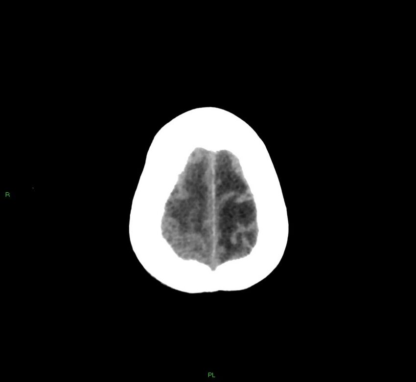 Basal ganglia hemorrhage (Radiopaedia 58766-65988 Axial non-contrast 11).jpg