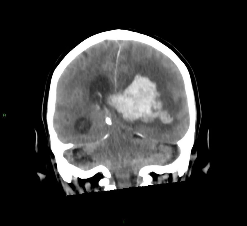 Basal ganglia hemorrhage (Radiopaedia 58775-66008 Coronal non-contrast 27).jpg