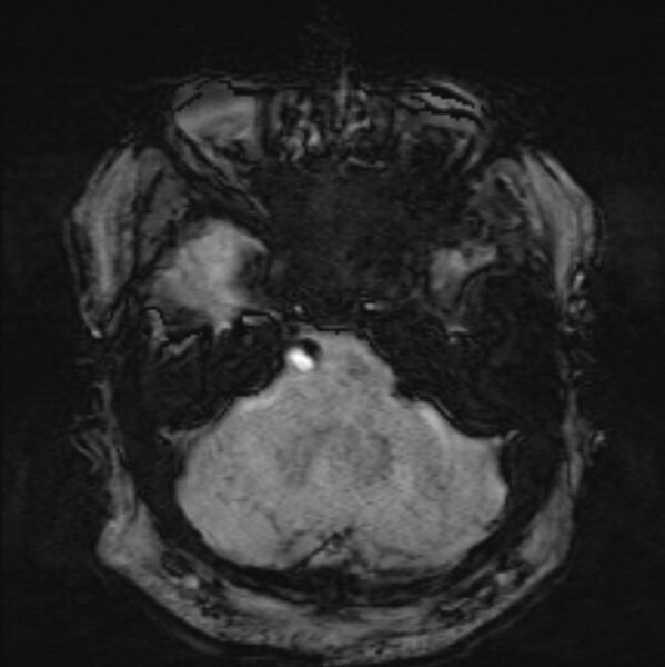 File:Basilar artery dissection (Radiopaedia 77032-88976 Axial SWI 13).jpg