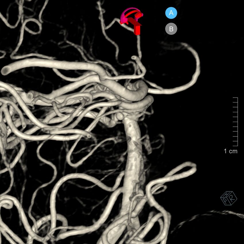 Basilar artery perforator aneurysm (Radiopaedia 82455-97734 3D view left VA 146).jpg