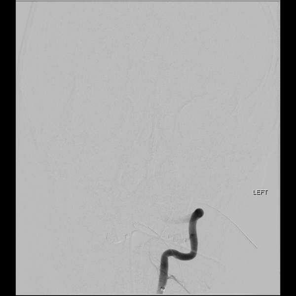 File:Basilar tip thrombus with endovascular clot retrieval (Radiopaedia 46320-50726 B 5).png