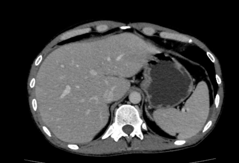 File:Behçet's disease- abdominal vasculitis (Radiopaedia 55955-62570 A 10).jpg