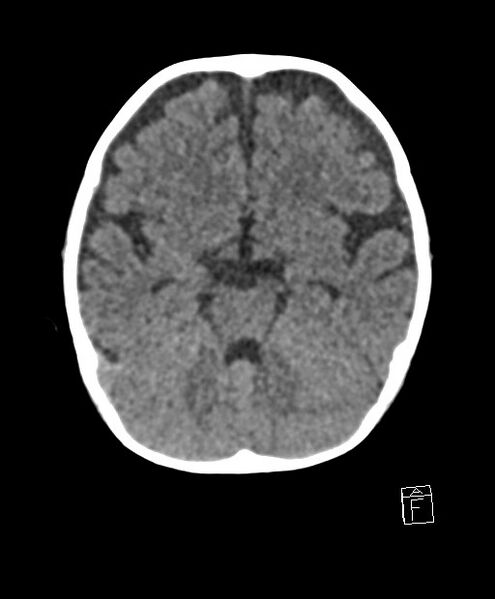File:Benign enlargement of subarachnoid spaces in infancy (BESS) (Radiopaedia 87459-103795 Axial non-contrast 59).jpg