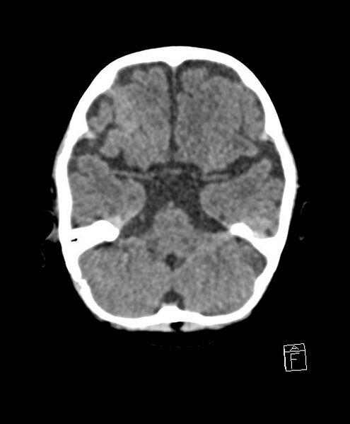 File:Benign enlargement of subarachnoid spaces in infancy (BESS) (Radiopaedia 87459-103795 Axial non-contrast 66).jpg