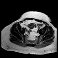 Benign seromucinous cystadenoma of the ovary (Radiopaedia 71065-81300 B 11).jpg