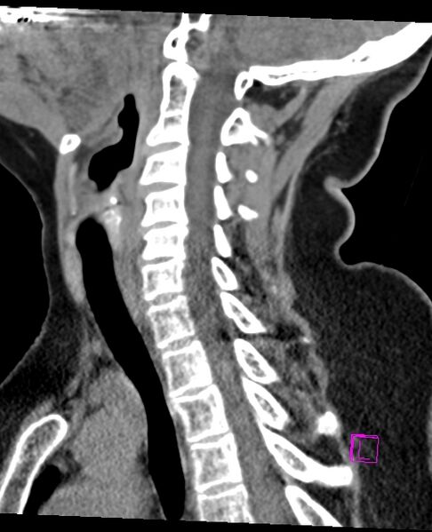 File:Bilateral atlanto-occipital assimilation (Radiopaedia 28350-28603 D 44).jpg