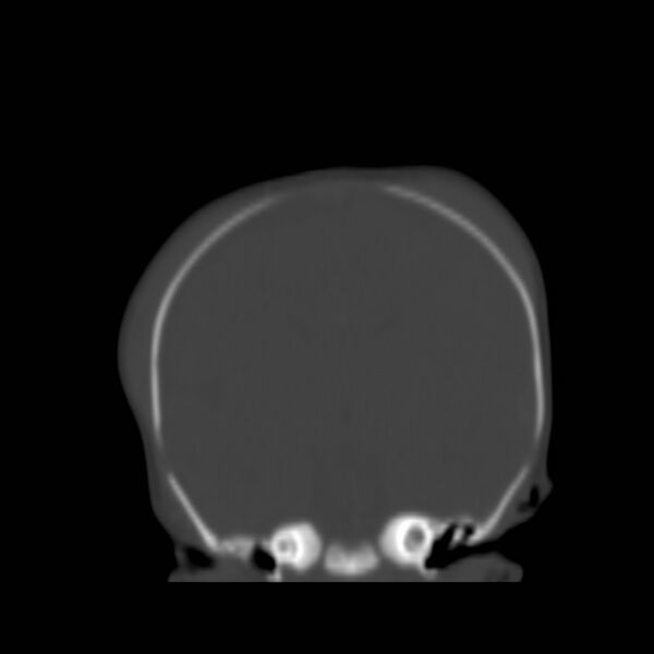 File:Bilateral cephalohematomas and subdural hematomas (Radiopaedia 26778-26929 Coronal bone window 12).jpg