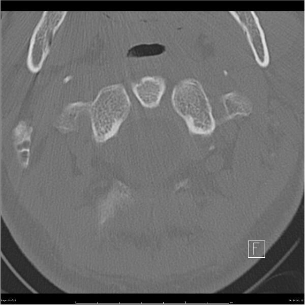 File:Bilateral cervical ribs (Radiopaedia 25868-26017 Axial bone window 8).jpg
