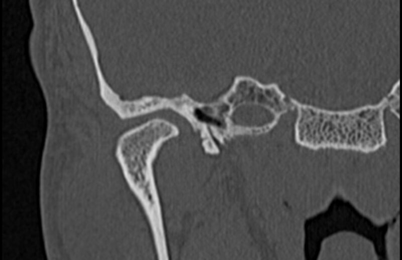 File:Bilateral cholesteatoma (Radiopaedia 54898-61172 Coronal bone window 9).jpg