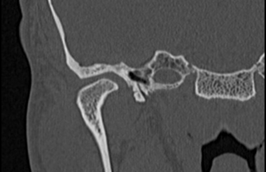 Bilateral cholesteatoma (Radiopaedia 54898-61172 Coronal bone window 9).jpg
