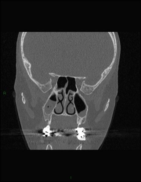 File:Bilateral frontal mucoceles (Radiopaedia 82352-96454 Coronal 183).jpg