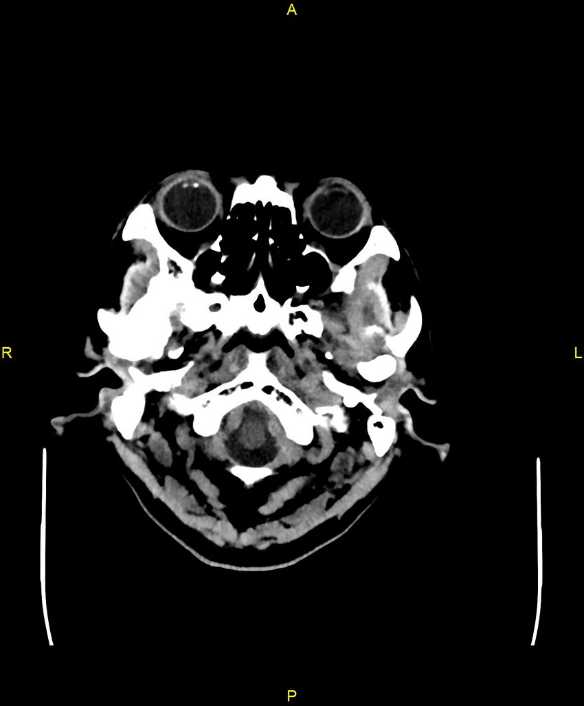Bilateral isodense subdural hematomas (Radiopaedia 88621-105325 Axial non-contrast 7).jpg