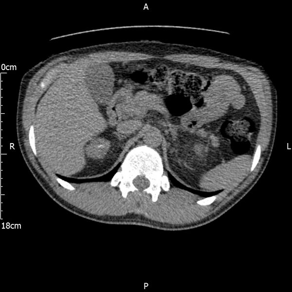 File:Bilateral medullary nephrocalcinosis with ureteric calculi (Radiopaedia 71269-81569 Axial non-contrast 30).jpg