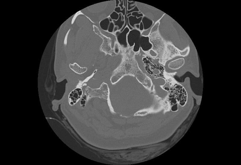 File:Bilateral otospongiosis (Radiopaedia 35447-36940 Axial bone window 8).jpg