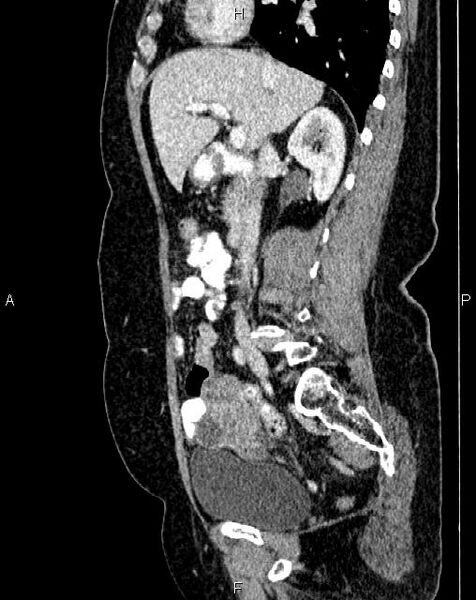 File:Bilateral ovarian serous cystadenocarcinoma (Radiopaedia 86062-101989 E 31).jpg