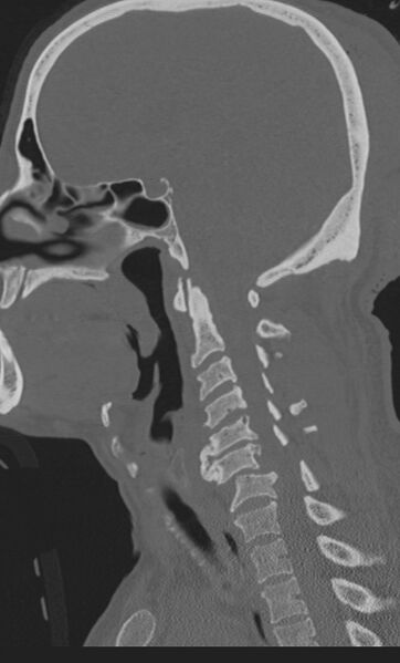 File:Bilateral perched facet joint (Radiopaedia 63149-71669 Sagittal bone window 26).jpg