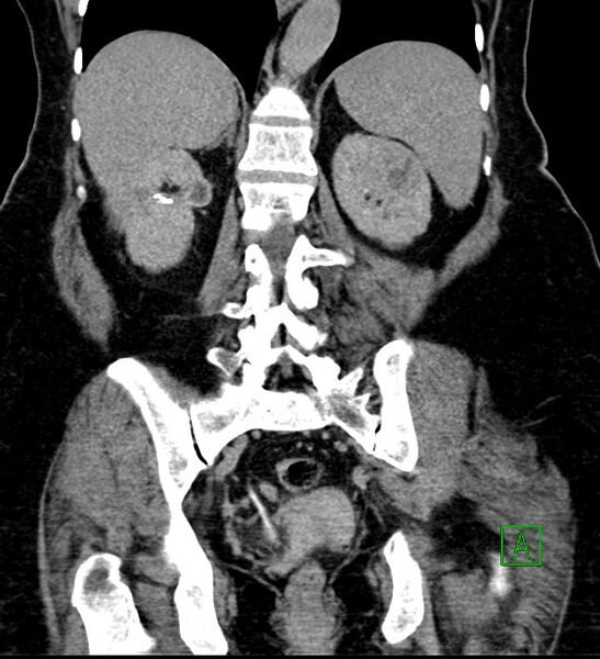File:Bilateral sporadic synchronous clear cell renal cell carcinoma (Radiopaedia 85035-100575 I 44).jpg