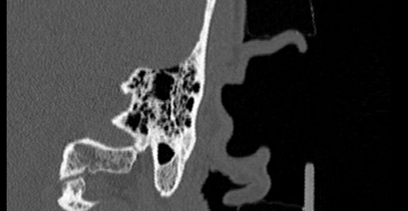 File:Bilateral temporal bone fractures (Radiopaedia 29482-29970 B 77).jpg