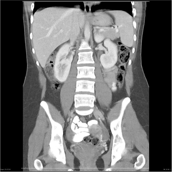 File:Bilateral ureteritis and cystitis (Radiopaedia 25340-25594 B 23).jpg