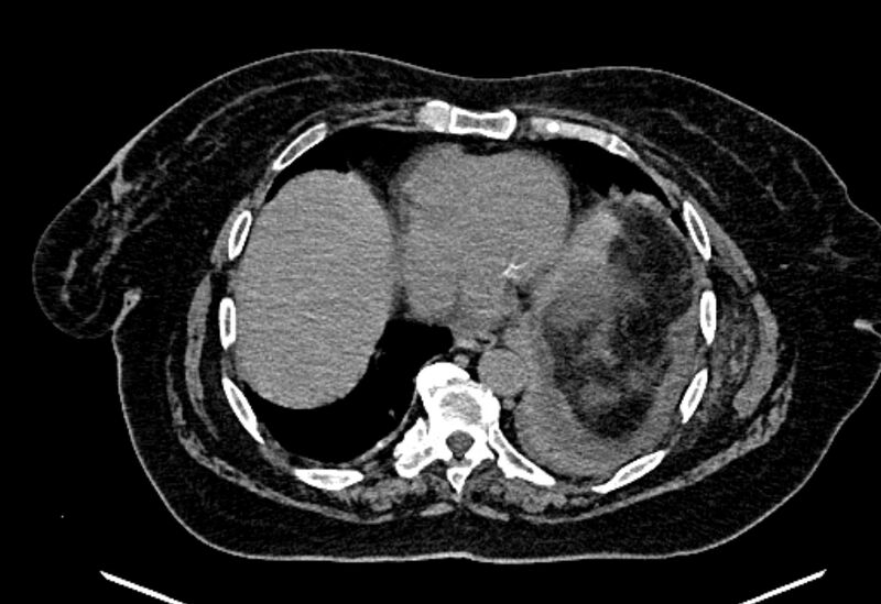 File:Biliary pancreatitis (Radiopaedia 72289-82823 Axial non-contrast 24).jpg