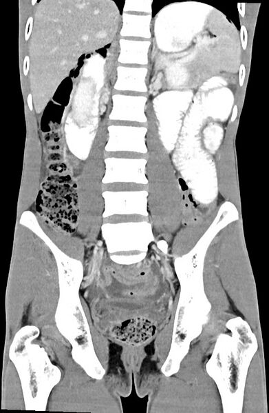 File:Blunt injury to the small bowel (Radiopaedia 74953-85987 B 60).jpg