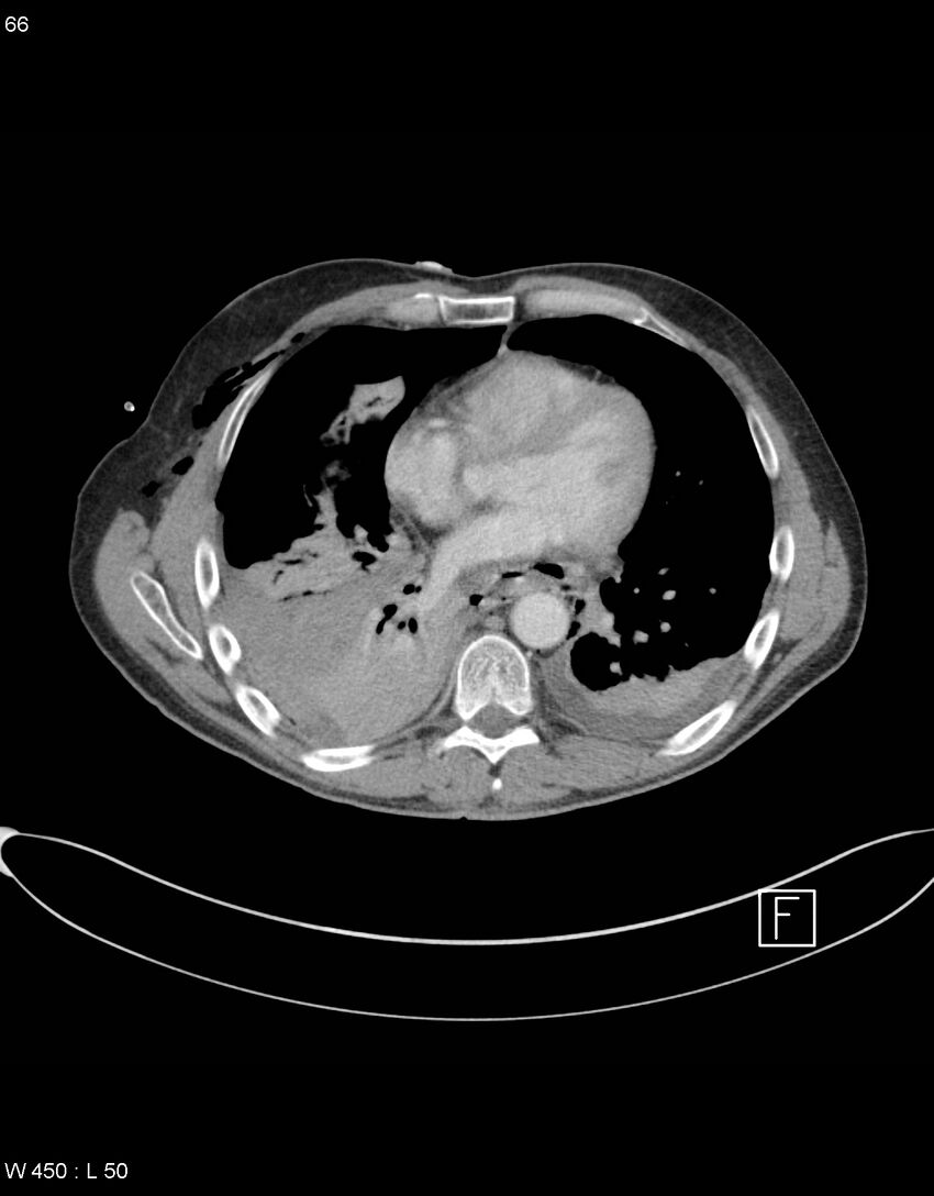 Boerhaave syndrome with tension pneumothorax (Radiopaedia 56794-63605 A 32).jpg