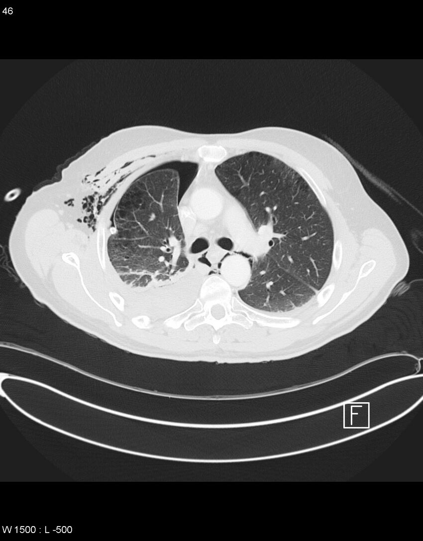 Boerhaave syndrome with tension pneumothorax (Radiopaedia 56794-63605 Axial lung window 22).jpg