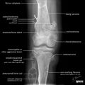 Bone lesion differential diagnosis - illustrations (Radiopaedia 79247-92261 A 1).jpg