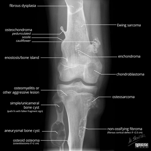 File:Bone lesion differential diagnosis - illustrations (Radiopaedia 79247-92261 A 1).jpg
