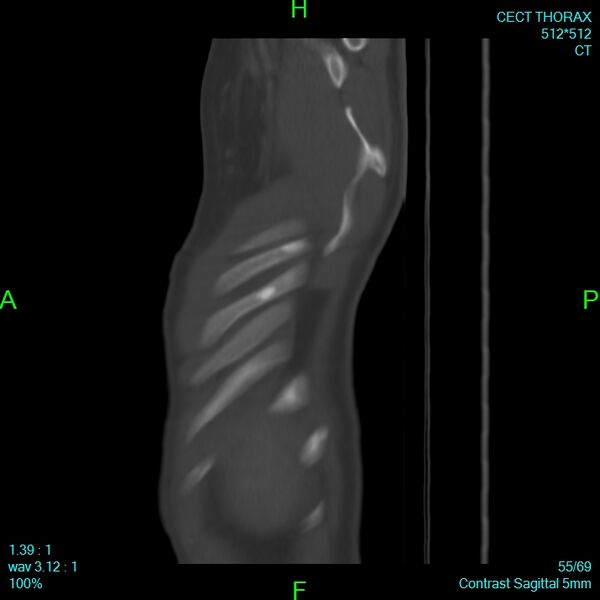 File:Bone metastases from lung carcinoma (Radiopaedia 54703-60937 Sagittal bone window 55).jpg