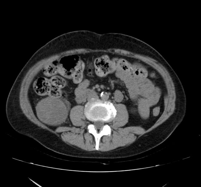 File:Bosniak renal cyst - type IV (Radiopaedia 22929-22953 Axial non-contrast 31).jpg