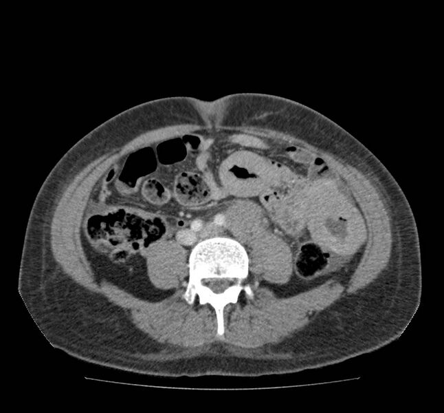 File:Bowel lymphoma complicated by bleeding after therapy (Radiopaedia 55601-62107 A 51).jpg
