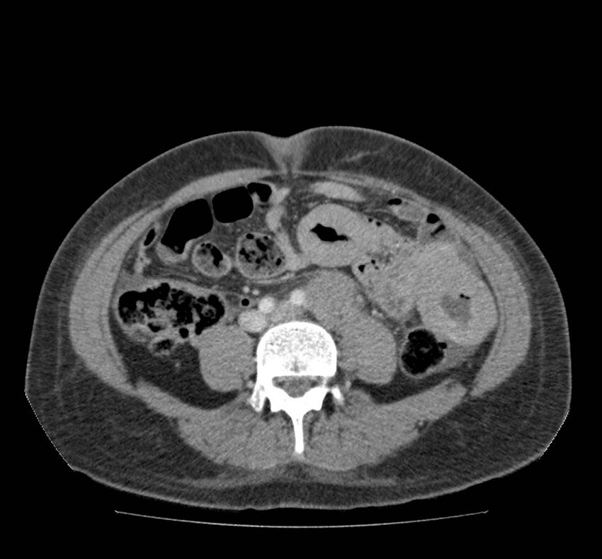 Bowel lymphoma complicated by bleeding after therapy (Radiopaedia 55601-62107 A 51).jpg