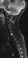Brachial plexus birth palsy (Radiopaedia 68118-77604 Sagittal STIR 4).jpg