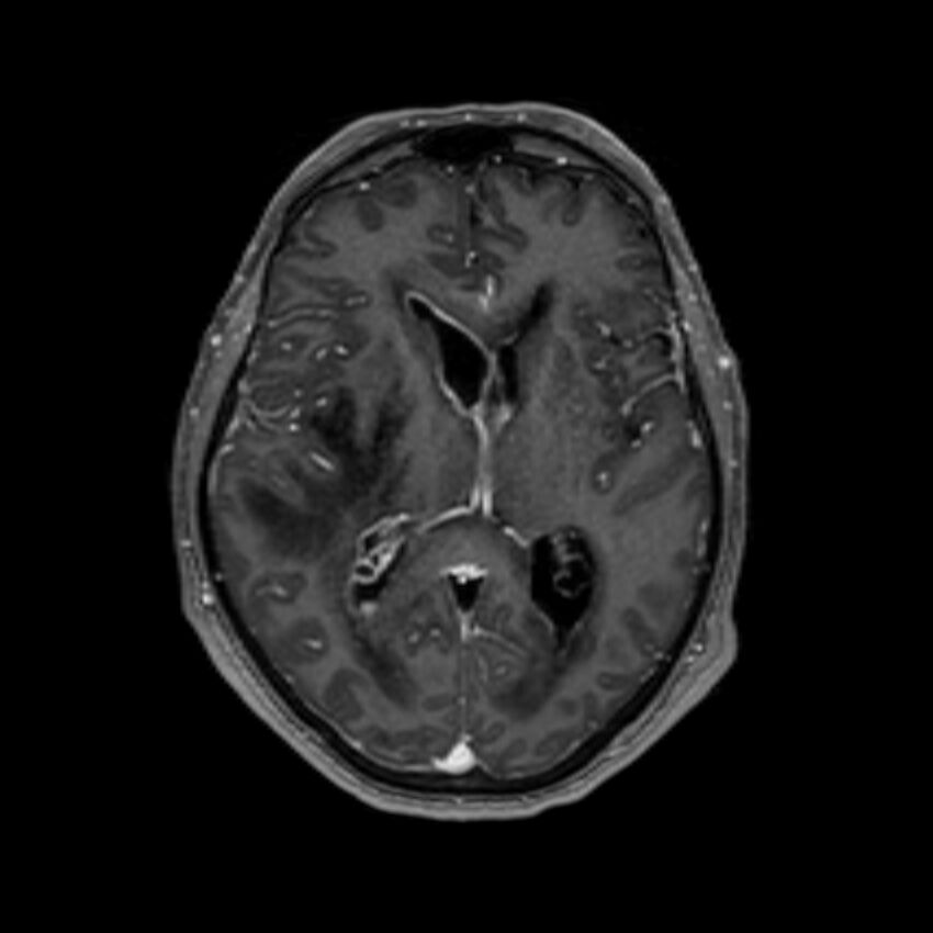 Brain abscess complicated by intraventricular rupture and ventriculitis (Radiopaedia 82434-96577 Axial T1 C+ 35).jpg