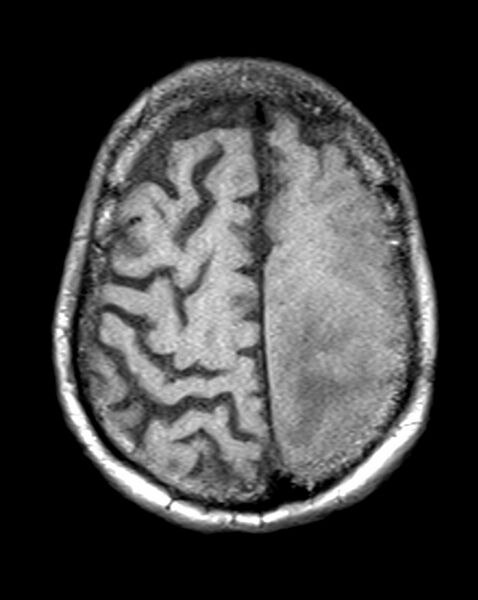 File:Brain abscess with dual rim sign (Radiopaedia 87566-103938 Axial T1 20).jpg