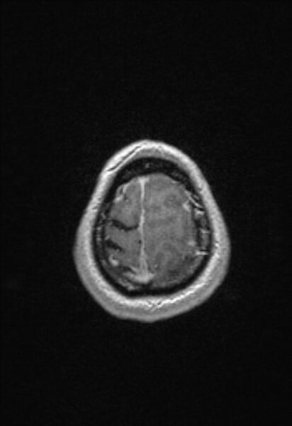 File:Brain abscess with ventriculitis (Radiopaedia 85703-101495 Axial T1 C+ 154).jpg