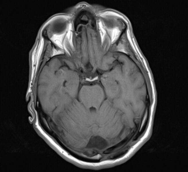 File:Brain metastases - lung cancer primary (Radiopaedia 75060-86115 Axial T1 10).jpg