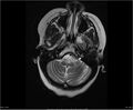 Brainstem glioma (Radiopaedia 21819-21775 Axial T2 7).jpg