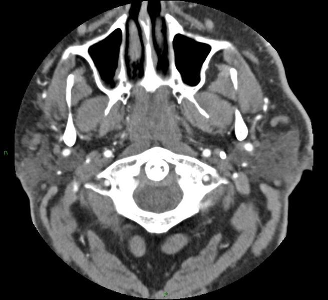 File:Brainstem hemorrhage (Radiopaedia 58794-66028 D 3).jpg