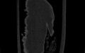 Breast carcinoma with pathological hip fracture (Radiopaedia 60314-67993 Coronal bone window 107).jpg