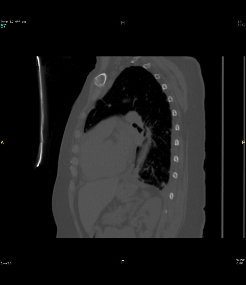 Breast primary with lung and bone metastases (Radiopaedia 40620-43228 Sagittal bone window 57).jpg