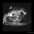 Broad ligament fibroid (Radiopaedia 49135-54241 Axial ADC 8).jpg