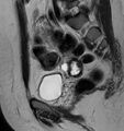 Broad ligament leiomyoma (Radiopaedia 81634-95516 Sagittal T2 11).jpg