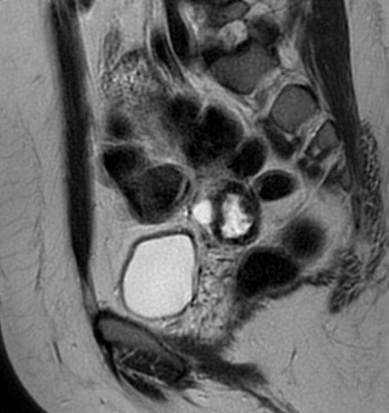 File:Broad ligament leiomyoma (Radiopaedia 81634-95516 Sagittal T2 11).jpg