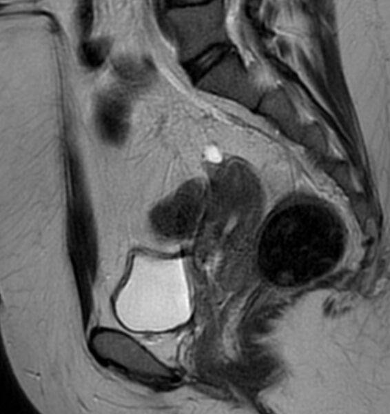 File:Broad ligament leiomyoma (Radiopaedia 81634-95516 Sagittal T2 17).jpg